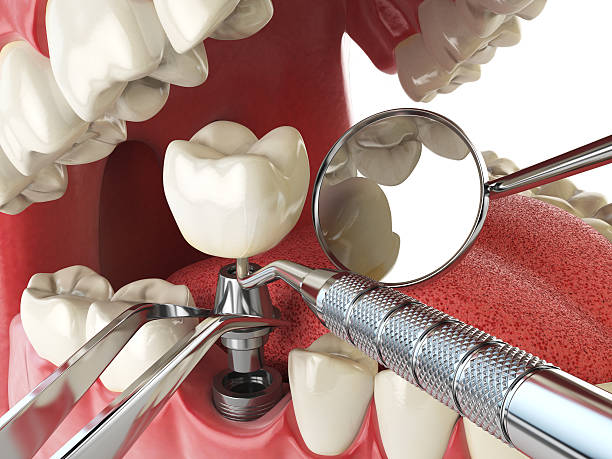 Best Emergency Root Canal Treatment in Atoka, NM